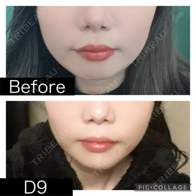 脂肪溶解注射（顔） SK新宿歌舞伎町美容外科・歯科 DAY 9 メイン用