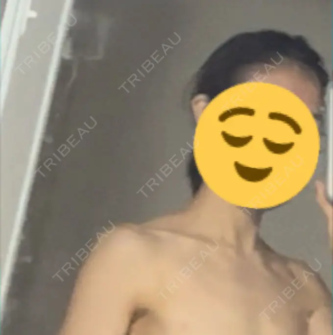 ボトックス（肩） LOUIS CLINIC 二子玉川院【ルイクリニック】 DAY 87 メイン用