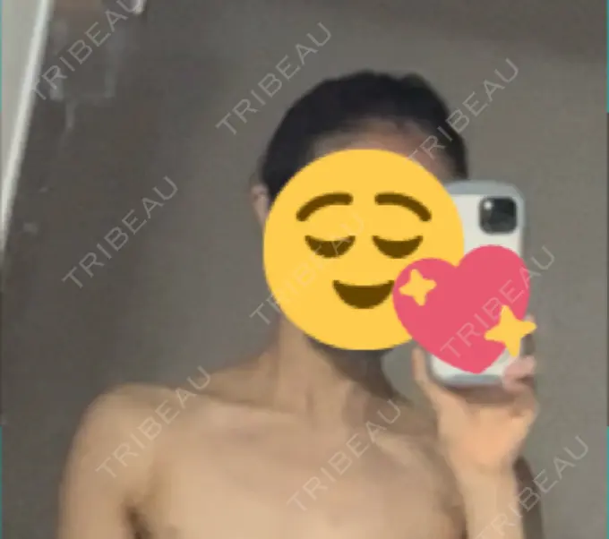 ボトックス（肩） LOUIS CLINIC 二子玉川院【ルイクリニック】 DAY 87 メイン用