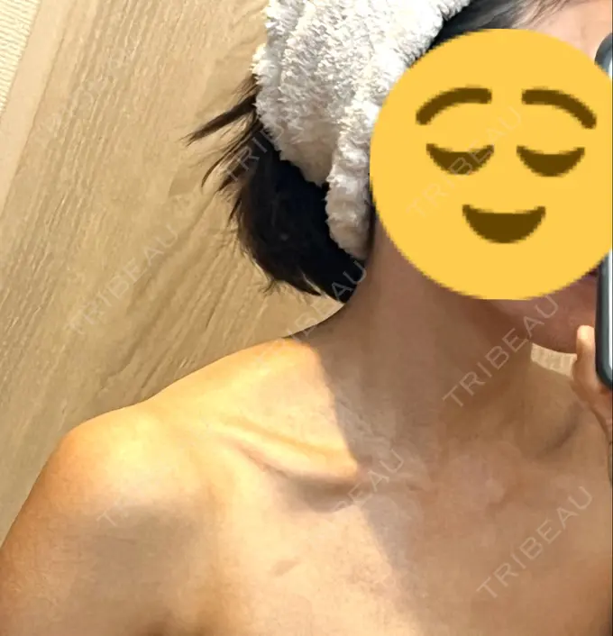 ボトックス（肩） LOUIS CLINIC 二子玉川院【ルイクリニック】 DAY 102 メイン用