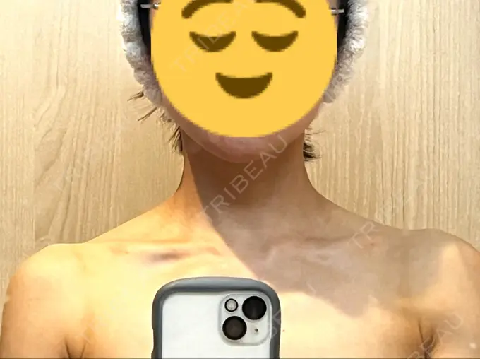 ボトックス（肩） LOUIS CLINIC 二子玉川院【ルイクリニック】 AFTER メイン用