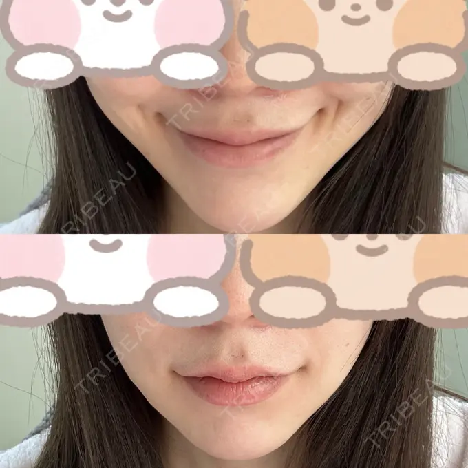 糸リフト / バッカルファット除去 RIVER CLINIC（リバークリニック） DAY 7 メイン用