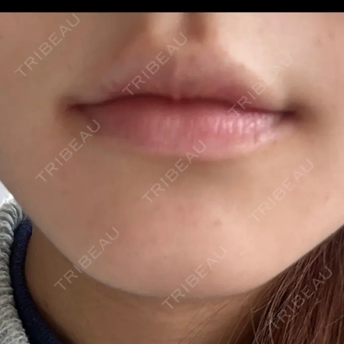 ヒアルロン酸注入（唇） TCB東京中央美容外科 草津院 AFTER メイン用