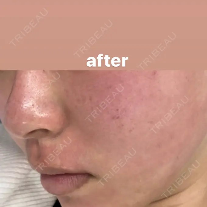 ポテンツァ 渋谷美容外科クリニック 渋谷院 DAY 0 メイン用