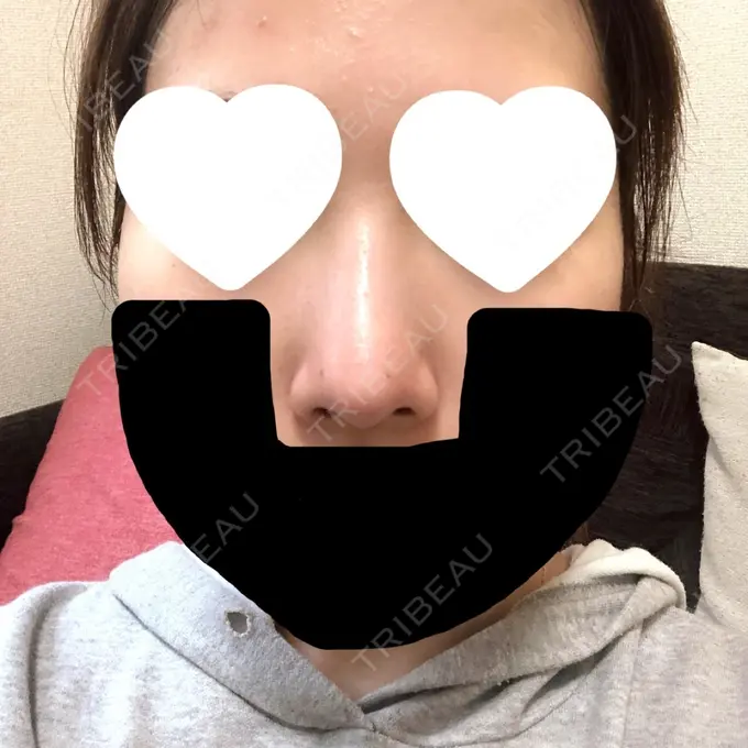 鼻尖形成（切開） / 軟骨移植 グローバルビューティークリニック 大阪院 DAY 43 メイン用