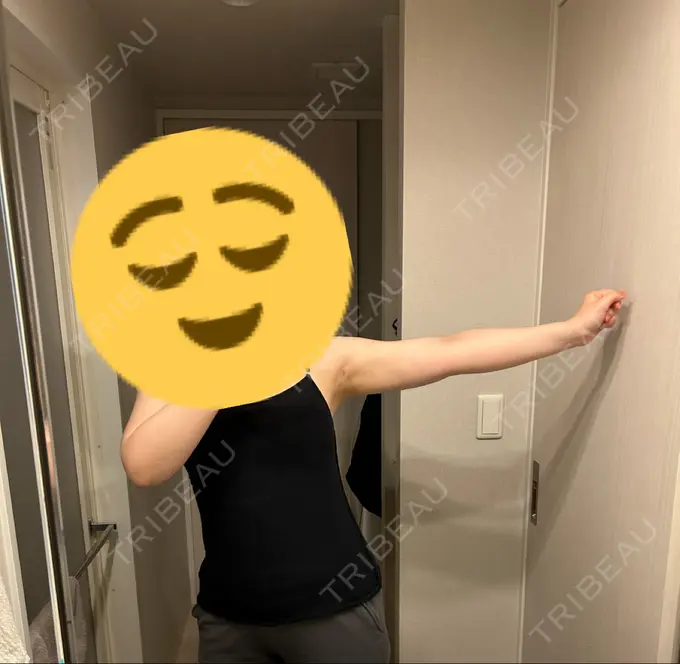 脂肪吸引（二の腕） Mods Clinic（モッズクリニック） 福岡院 DAY 35 メイン用