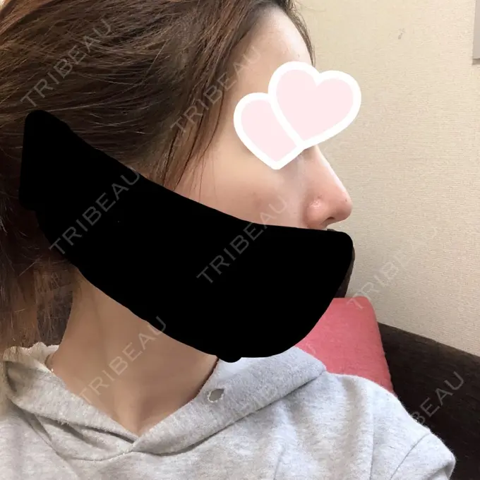 鼻尖形成（切開） / 軟骨移植 グローバルビューティークリニック 大阪院 DAY 43 メイン用