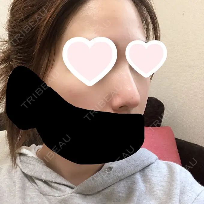 鼻尖形成（切開） / 軟骨移植 グローバルビューティークリニック 大阪院 DAY 43 メイン用