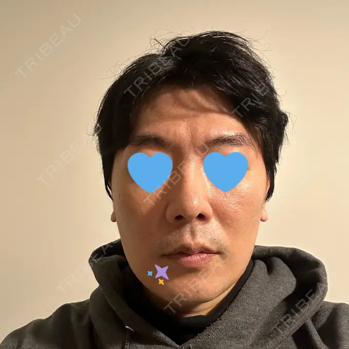 糸リフト / バッカルファット除去 / 脂肪吸引（顔） / メーラーファット除去 / ボトックス（エラ・小顔） RIVER CLINIC（リバークリニック） DAY 16 メイン用