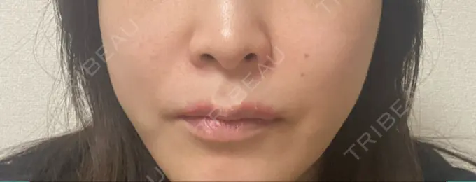 脂肪溶解注射（顔） 東京たかはしクリニック 練馬院 AFTER メイン用