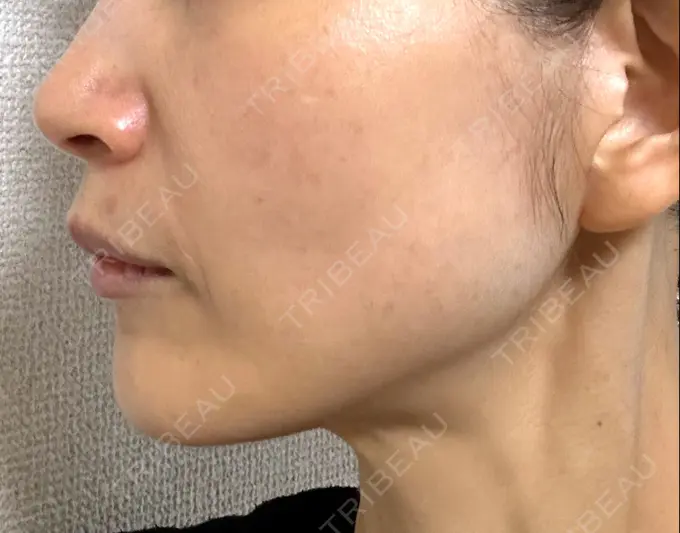 ルビーレーザー S-Laboクリニック 渋谷院 AFTER メイン用