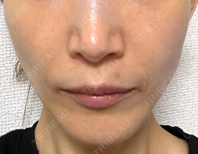 ルビーレーザー S-Laboクリニック 渋谷院 DAY 18 メイン用