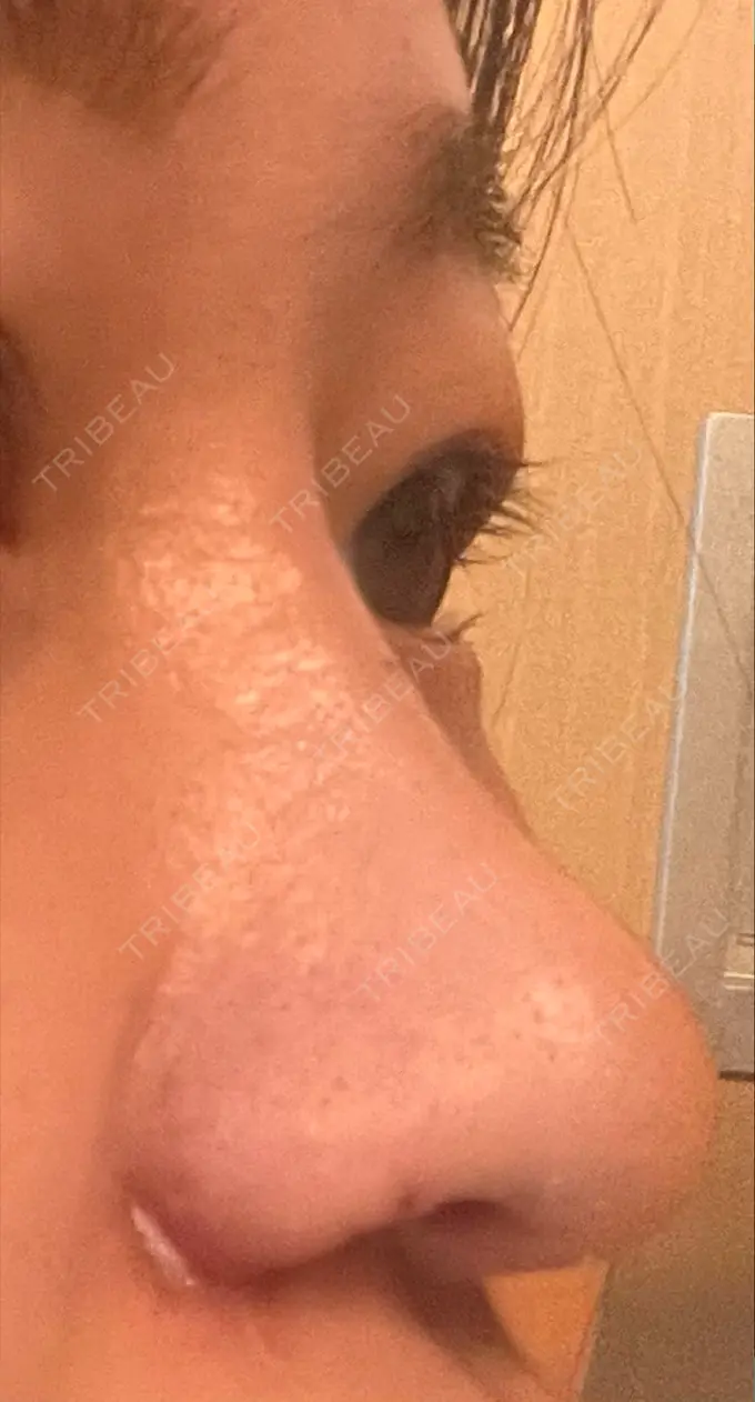 隆鼻術 / 鼻尖形成（切開） / 小鼻縮小（切開） / 軟骨移植 グローバルビューティークリニック 銀座院 DAY 14 メイン用