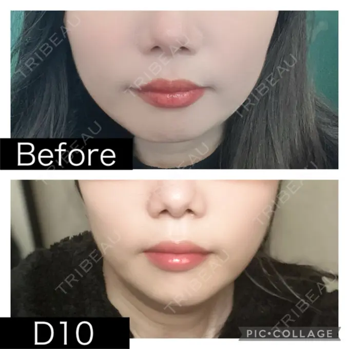 脂肪溶解注射（顔） SK新宿歌舞伎町美容外科・歯科 DAY 10 メイン用