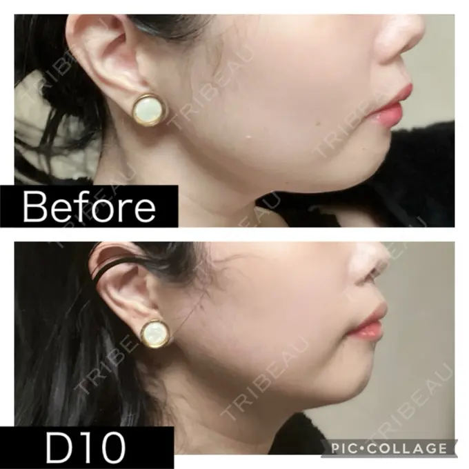 脂肪溶解注射（顔） SK新宿歌舞伎町美容外科・歯科 DAY 10 メイン用