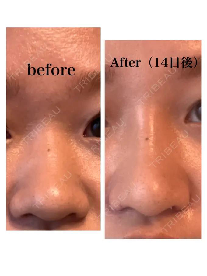 隆鼻術 / 鼻尖形成（切開） / 小鼻縮小（切開） / 軟骨移植 グローバルビューティークリニック 銀座院 DAY 14 メイン用