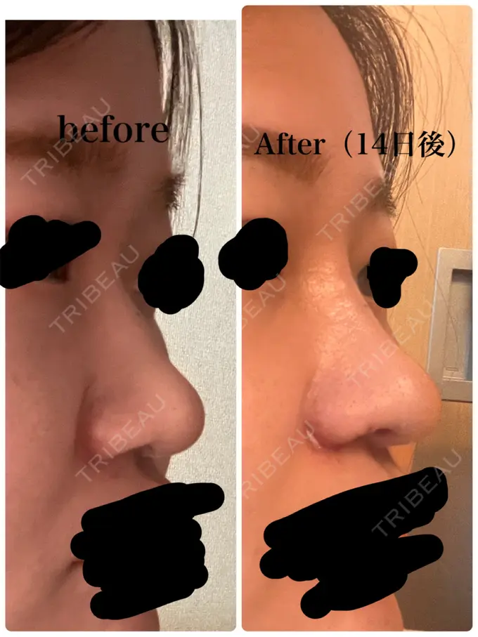 隆鼻術 / 鼻尖形成（切開） / 小鼻縮小（切開） / 軟骨移植 グローバルビューティークリニック 銀座院 DAY 14 メイン用