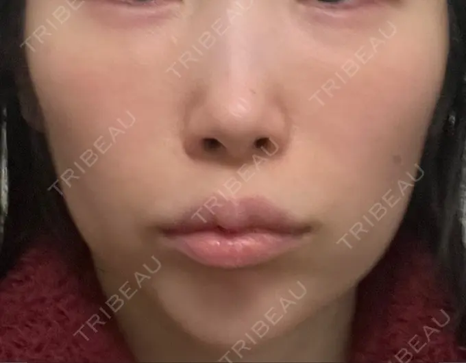 ハイフ（顔） 椿クリニック 心斎橋院 DAY 23 メイン用