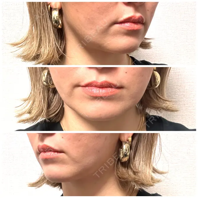 ジョールファット除去 / 脂肪吸引注射（顔） ziz CLINIC DAY 11 メイン用