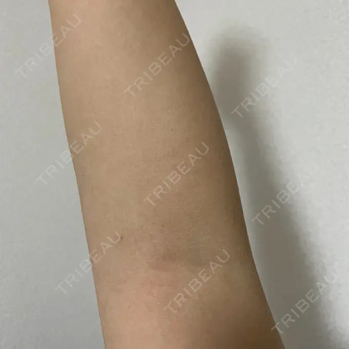 白玉点滴・注射 美容皮膚科エルムクリニック 麻布院 AFTER メイン用