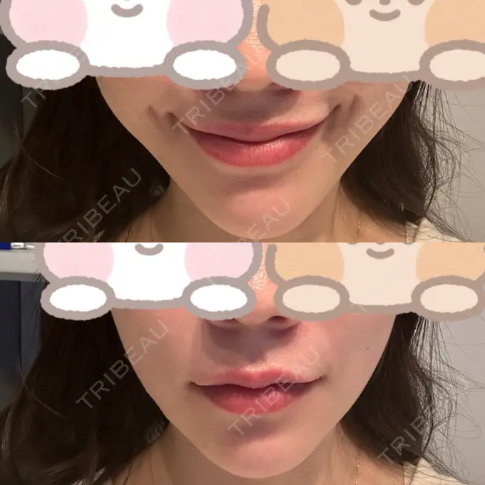 糸リフト / バッカルファット除去 RIVER CLINIC（リバークリニック） DAY 8 メイン用