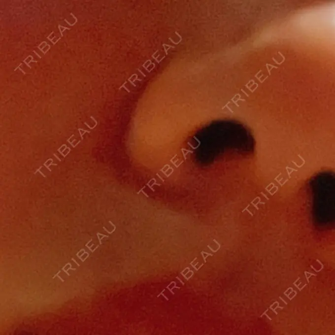 鼻中隔延長（非切開） / ボトックス（エラ・小顔） TCB東京中央美容外科 町田院 AFTER メイン用