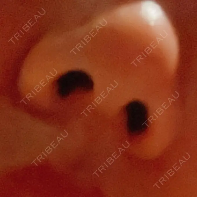 鼻中隔延長（非切開） / ボトックス（エラ・小顔） TCB東京中央美容外科 町田院 DAY 28 メイン用