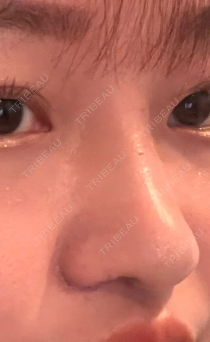 隆鼻術 / 鼻尖形成（切開） / 小鼻縮小（切開） / 軟骨移植 グローバルビューティークリニック 銀座院 DAY 15 メイン用