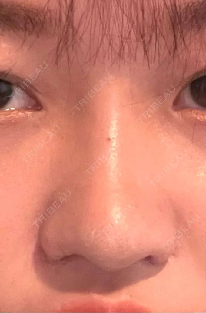 隆鼻術 / 鼻尖形成（切開） / 小鼻縮小（切開） / 軟骨移植 グローバルビューティークリニック 銀座院 DAY 15 メイン用