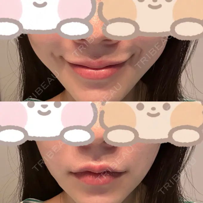 糸リフト / バッカルファット除去 RIVER CLINIC（リバークリニック） DAY 9 メイン用