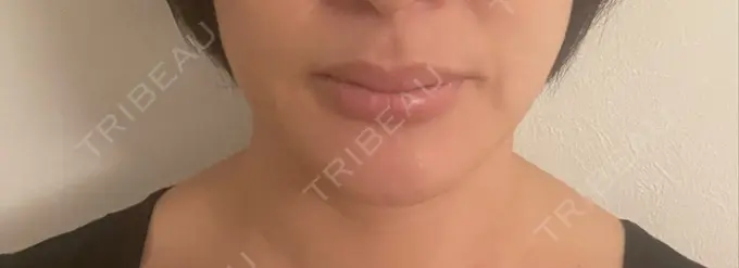 脂肪溶解注射（顔） 表参道ウィズ・クリニック DAY 1 メイン用