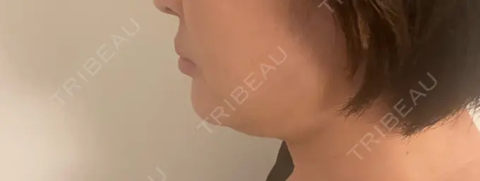 脂肪溶解注射（顔） 表参道ウィズ・クリニック DAY 1 メイン用