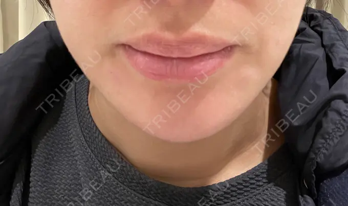 脂肪溶解注射（顔） 表参道ウィズ・クリニック AFTER メイン用