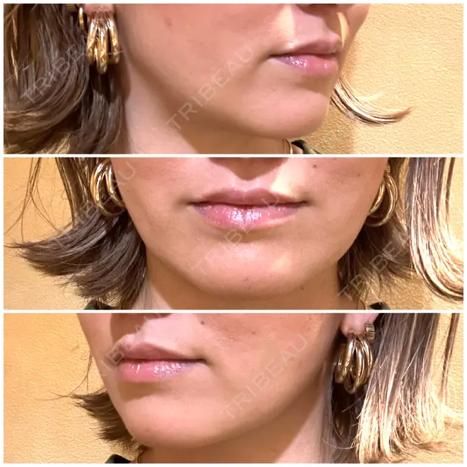 ジョールファット除去 / 脂肪吸引注射（顔） ziz CLINIC DAY 13 メイン用