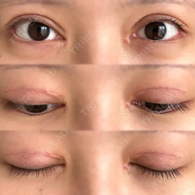 二重切開 / 目頭切開 / クマ治療 / 目尻切開 / 上まぶたたるみ取り / 下まぶたの脂肪取り / 脂肪注入（目の下） 湘南美容クリニック 大阪堺東院 DAY 50 メイン用