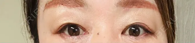 眉下切開 ルーチェクリニック 銀座院 DAY 7 メイン用