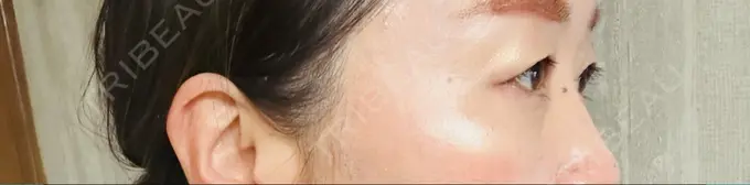 眉下切開 ルーチェクリニック 銀座院 DAY 7 メイン用