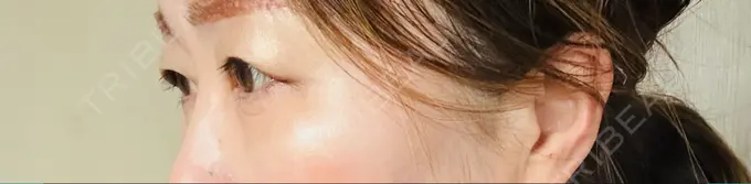 眉下切開 ルーチェクリニック 銀座院 DAY 7 メイン用