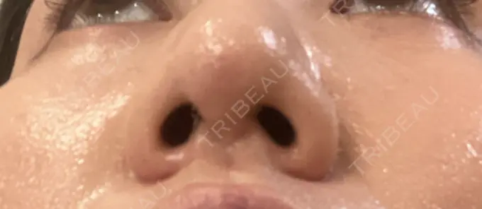 鼻尖形成（切開） / 鼻中隔延長（非切開） ASTRA BEAUTY CLINIC DAY 8 メイン用