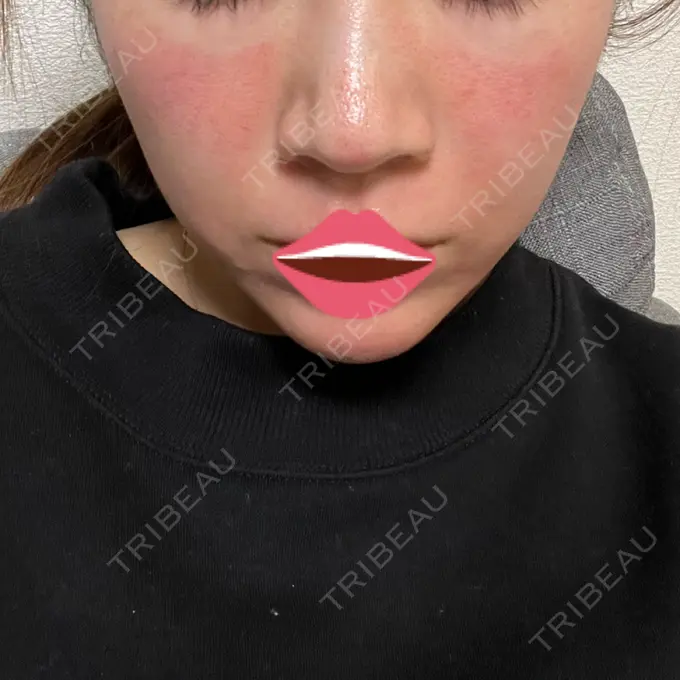 ダーマペン / ヴェルヴェットスキン 表参道メディカルクリニック 福岡天神院 DAY 1 メイン用