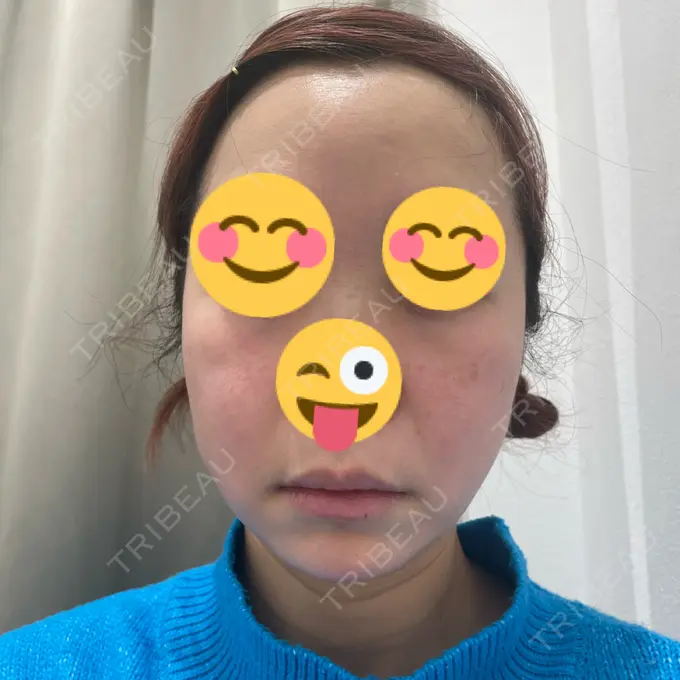 脂肪吸引（顔） / 下まぶたたるみ取り / ボトックス（エラ・小顔） / ハイフ（顔） TCB東京中央美容外科 梅田大阪駅前院 DAY 0 メイン用