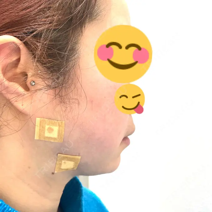 脂肪吸引（顔） / 下まぶたたるみ取り / ボトックス（エラ・小顔） / ハイフ（顔） TCB東京中央美容外科 梅田大阪駅前院 DAY 0 メイン用