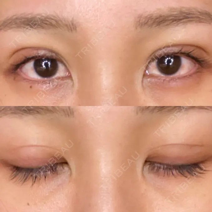 二重埋没 城本クリニック 大阪院 DAY 15 メイン用