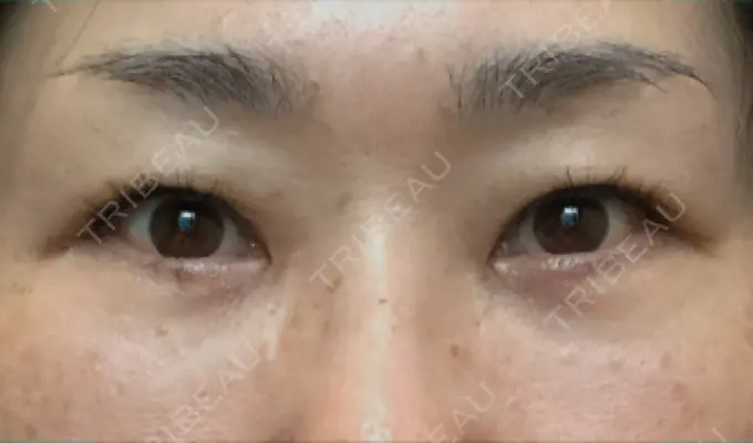 クマ治療 / 下まぶたたるみ取り / 下まぶたの脂肪取り / 目元修正 / その他（目元） 吉井クリニック AFTER メイン用