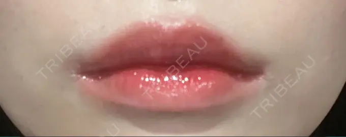 ヒアルロン酸注入（あご） / ボトックス（エラ・小顔） / ヒアルロン酸注入（唇） / ボトックス（口角） THE FIRST CLINIC 多摩センター院 DAY 2 メイン用