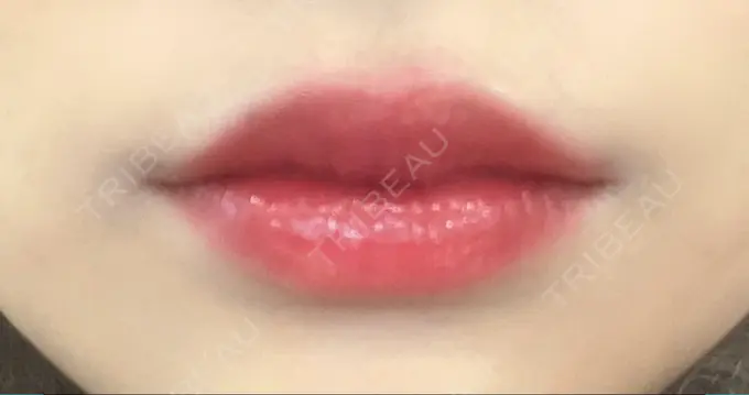 ヒアルロン酸注入（あご） / ボトックス（エラ・小顔） / ヒアルロン酸注入（唇） / ボトックス（口角） THE FIRST CLINIC 多摩センター院 AFTER メイン用