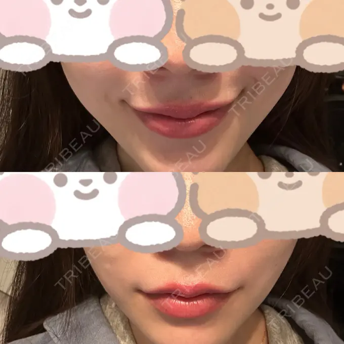 糸リフト / バッカルファット除去 RIVER CLINIC（リバークリニック） DAY 12 メイン用