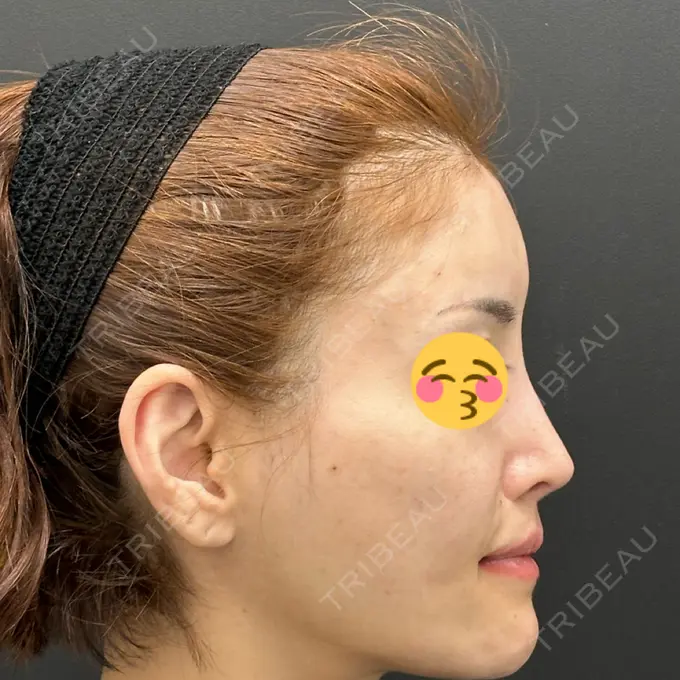 ヒアルロン酸注入（頬） シェリークリニック 新宿本院 DAY 0 メイン用