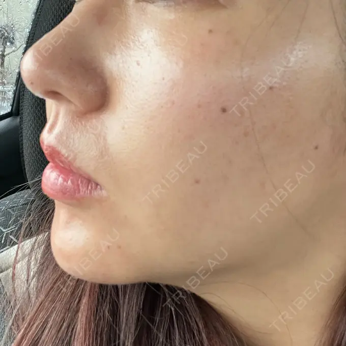 ボトックス（あご） / ヒアルロン酸注入（あご） / ヒアルロン酸注入（唇） 石倉クリニック 水戸院 AFTER メイン用