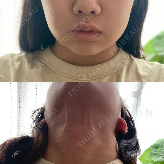 糸リフト / 脂肪吸引（顔） / ボトックス（エラ・小顔） 湘南美容クリニック 秋葉原院 DAY 52 メイン用